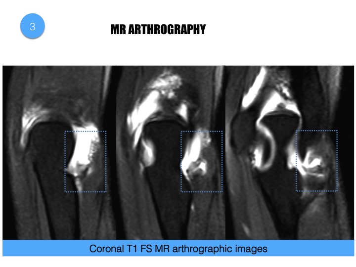 Figure 3 for case Elbow synovial fold syndrome (posterolateral impingement)